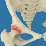 Osteoarthritis of the Hip